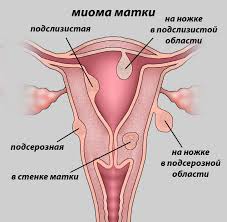 Миома матки